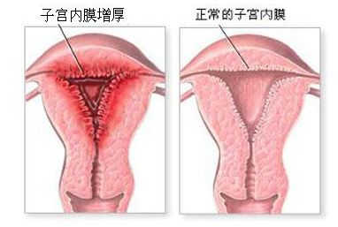 子宫内膜厚度是否影响泰国试管婴儿移植成功率?
