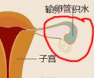 输卵管积水是不是试管婴儿成功率不高?