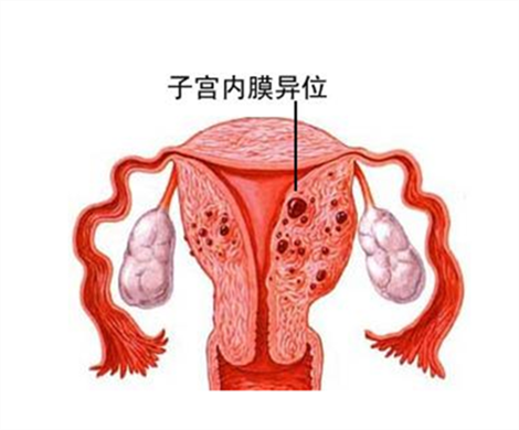 子宫内膜易位去做泰国试管婴儿困难吗?