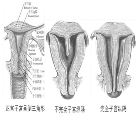 先天性子宫畸形如何做试管婴儿