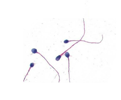 试管婴儿:精子的形态会影响受孕率吗?