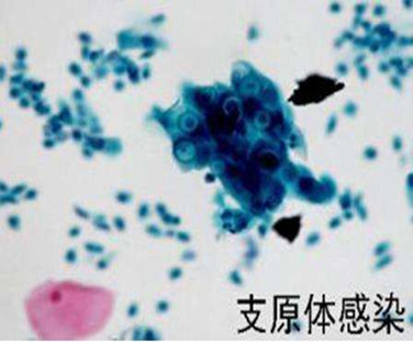 什么是衣原体,对试管婴儿有什么影响?
