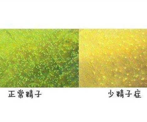少精症是怎么造成了试管患者不育?