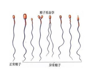 精子畸形并不等于胎儿畸形