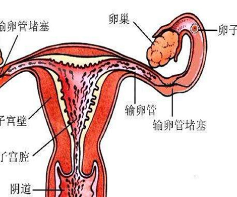 女性输卵管堵塞会出现哪些症状?