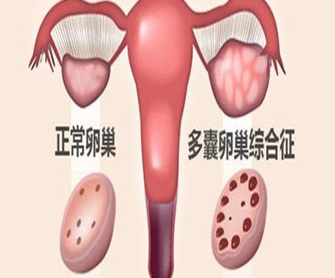 多囊性卵巢可以喝饮料吗？
