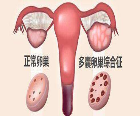 多囊卵巢做泰国试管婴儿前需要如何调理?