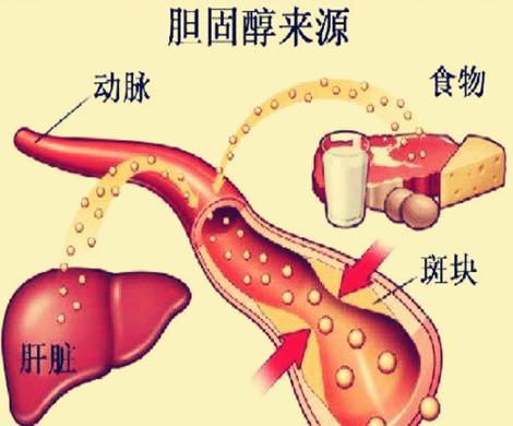 胆固醇影响怀孕?试管备孕阶段该怎样降低坏胆固醇含量?